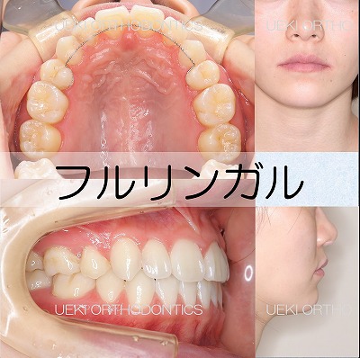 うえき矯正歯科 岡山市の矯正歯科