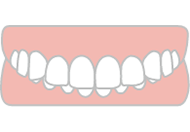 過蓋咬合（咬み合わせが深い）