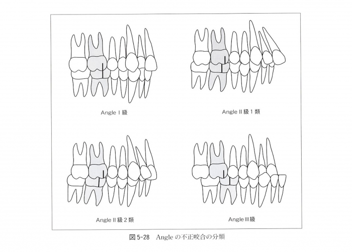 不正咬合の分類について（アングルの分類）