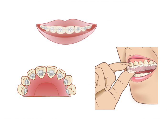 永久歯で用いる矯正装置の種類