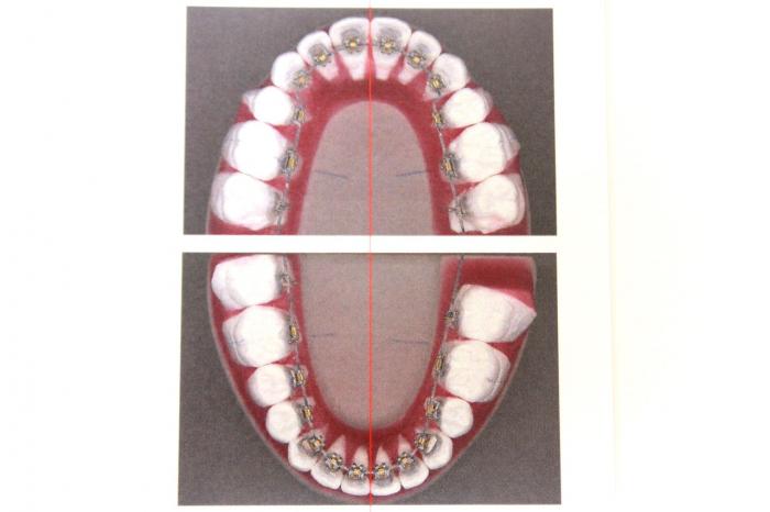 舌側矯正装置の接着方法と技工