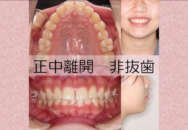 ⑤正中離開(表側矯正)