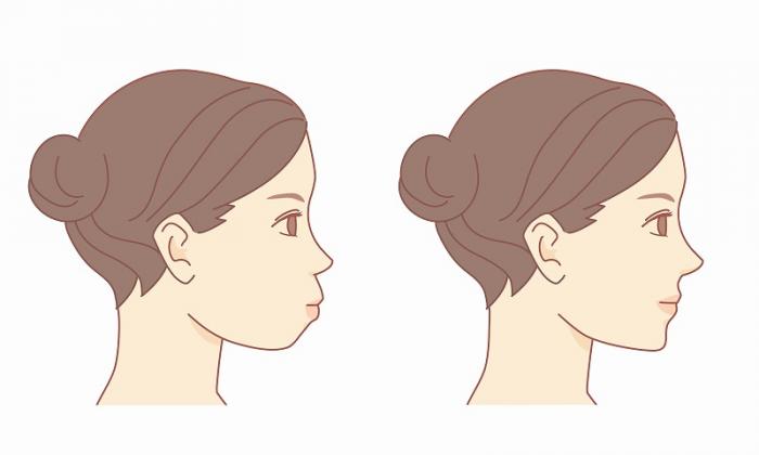 口元の突出感が気になる方の舌側矯正