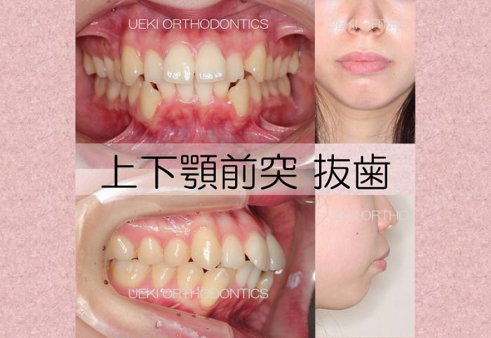 ⑳上下顎前突（表側矯正）
