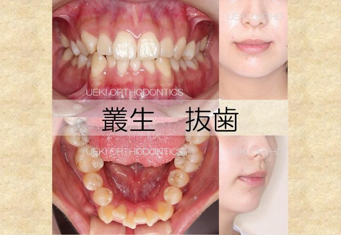 ㉑叢生(ハーフリンガル)