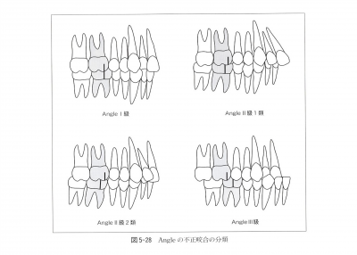 不正咬合の分類について（アングルの分類）