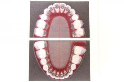 舌側矯正装置の接着方法と技工