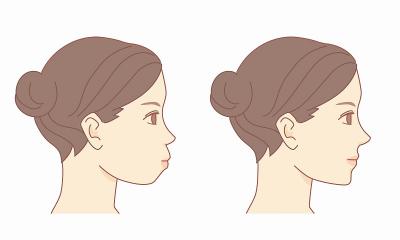 口元の突出感が気になる方の舌側矯正