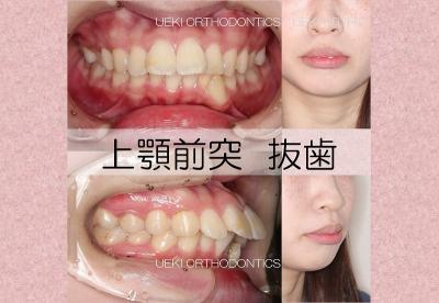 ⑰上顎前突（表側矯正）