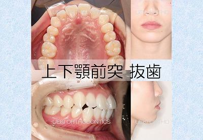 ⑲上下顎前突（フルリンガル）