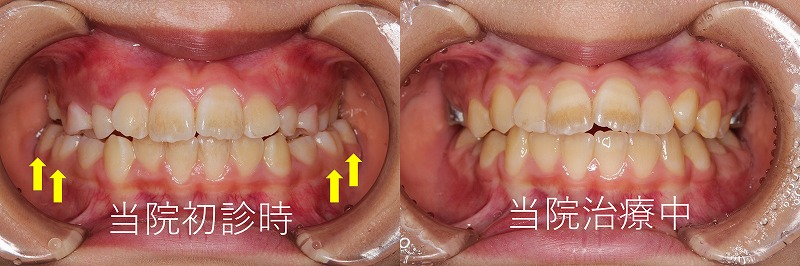 うえき矯正歯科 岡山市の矯正歯科