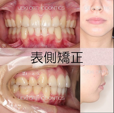 うえき矯正歯科 岡山市の矯正歯科