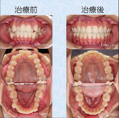 うえき矯正歯科 岡山市の矯正歯科