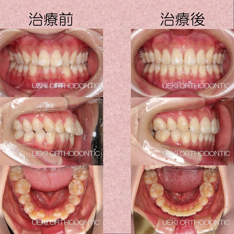 うえき矯正歯科 岡山市の矯正歯科