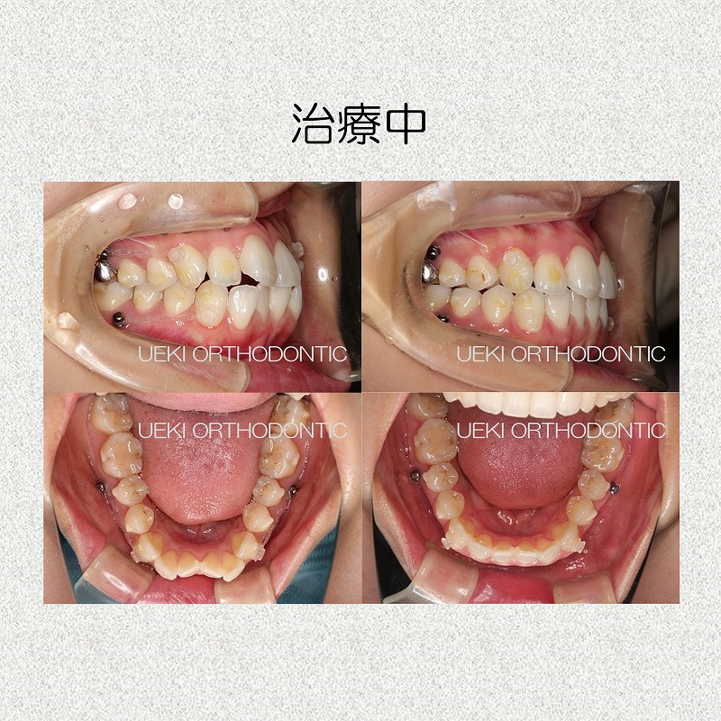 うえき矯正歯科 岡山市の矯正歯科