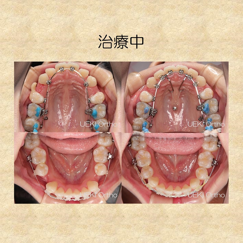 うえき矯正歯科 岡山市の矯正歯科