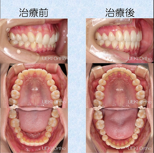 うえき矯正歯科 岡山市の矯正歯科