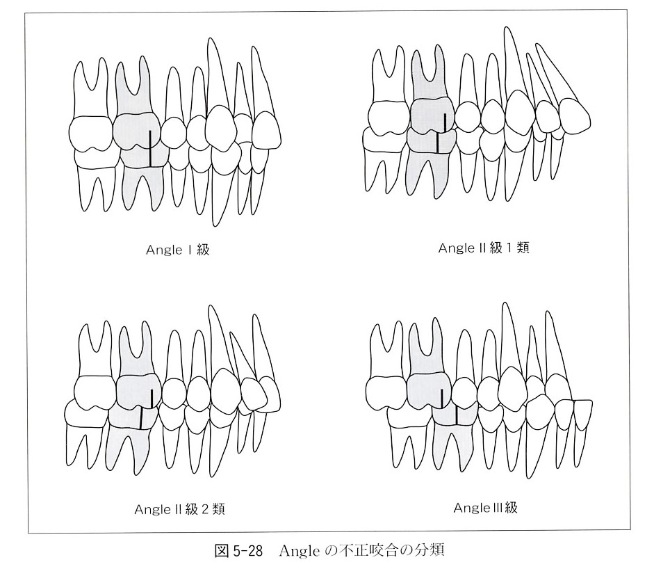 アングル の 不正 咬合