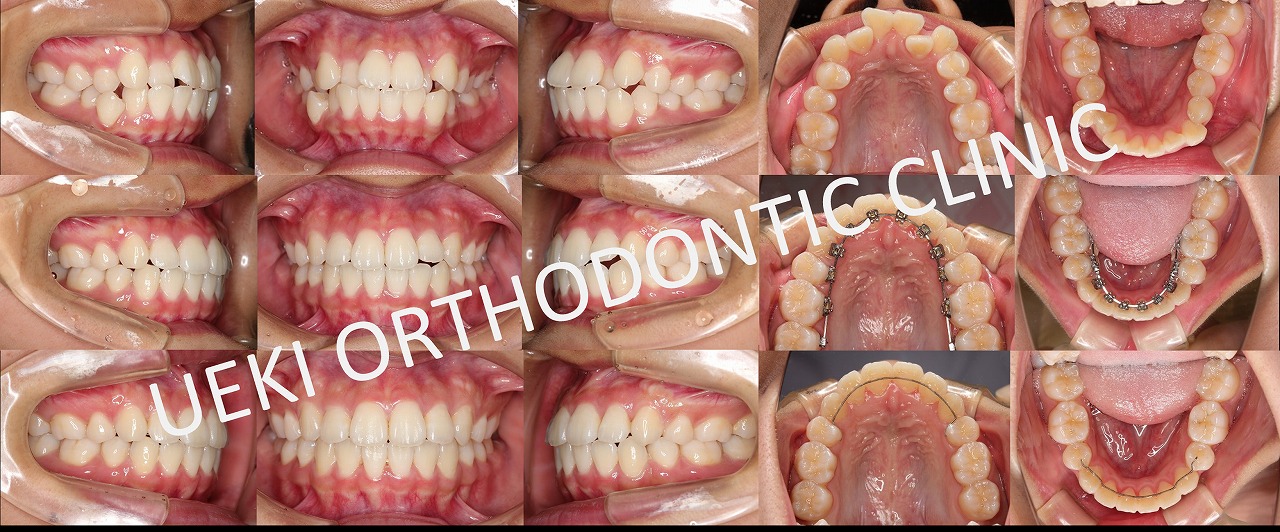 うえき矯正歯科 岡山市の矯正歯科