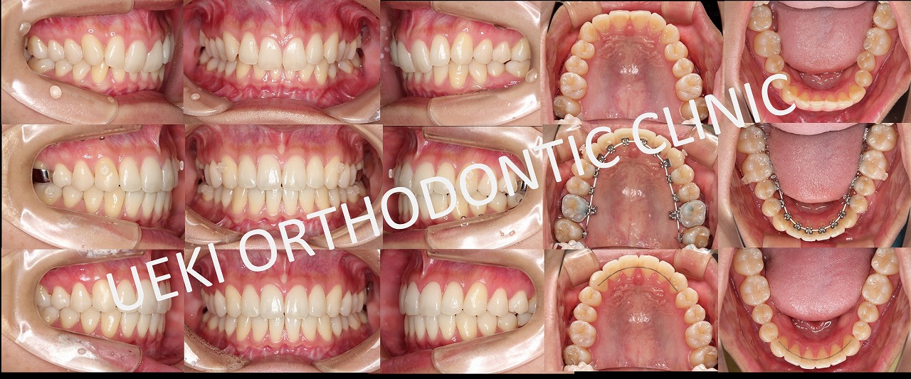 うえき矯正歯科 岡山市の矯正歯科