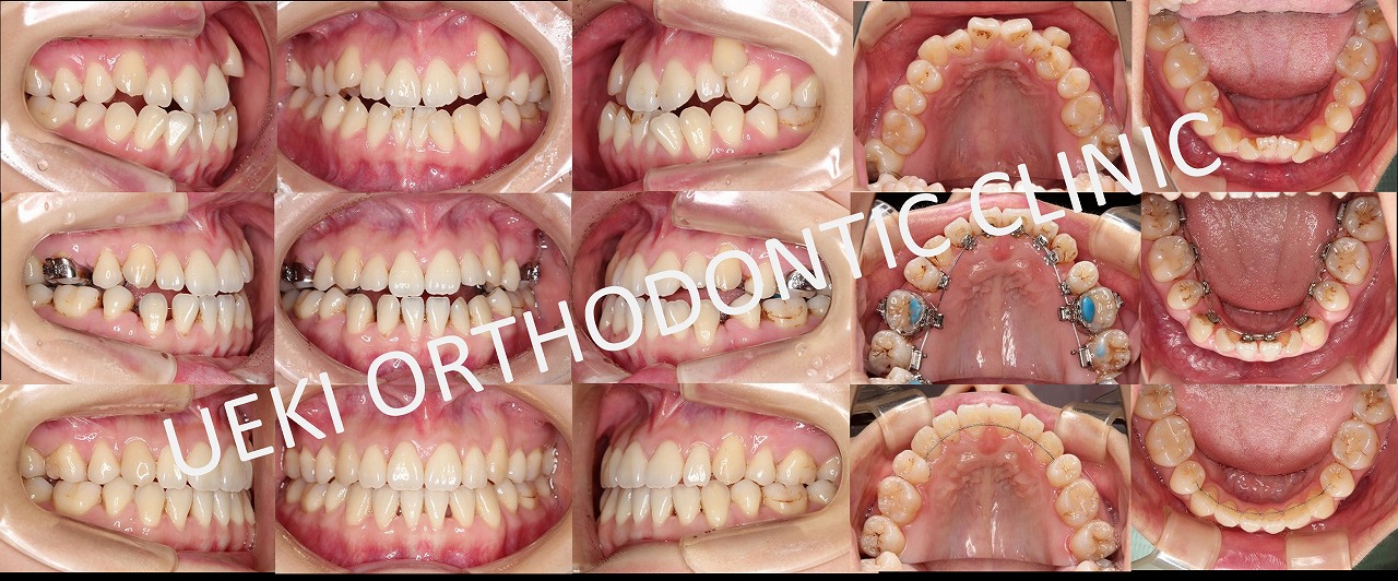 うえき矯正歯科 岡山市の矯正歯科